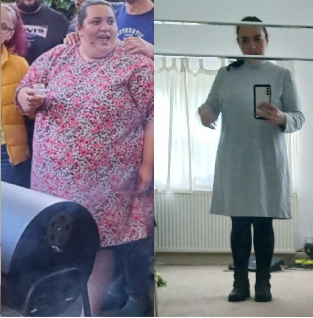 Photo of woman before gastric sleeve surgery