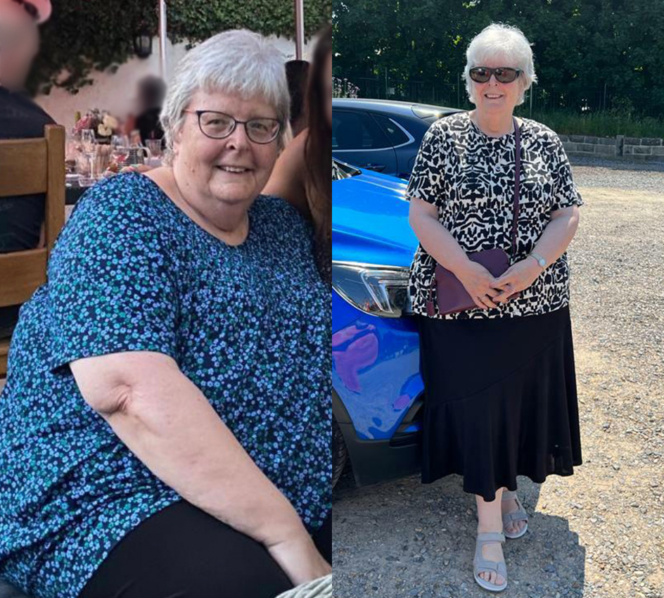 Before and After Photos of Gastric Band to Bypass Revision