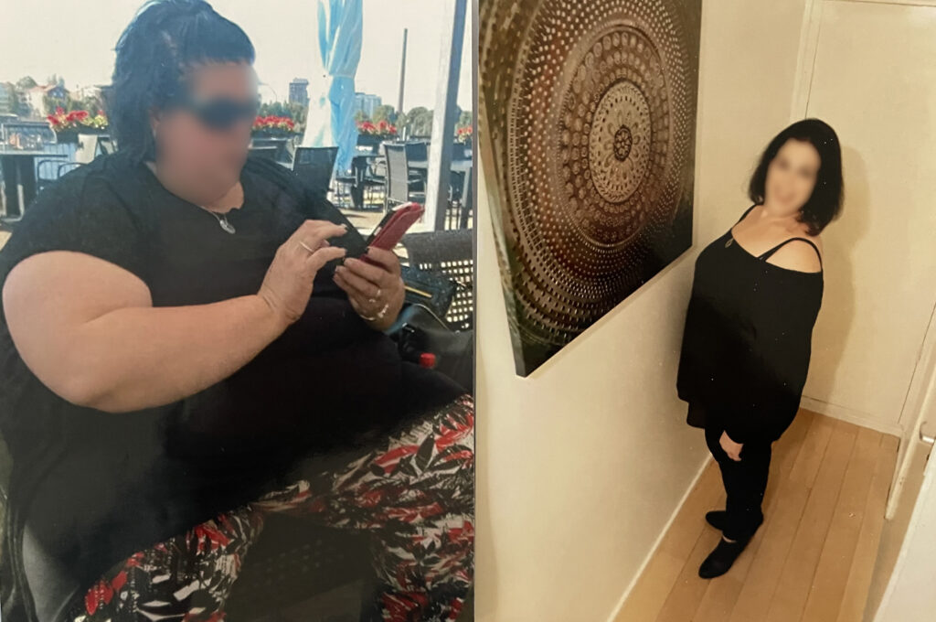 Before Gastric Band to Bypass Revision Image