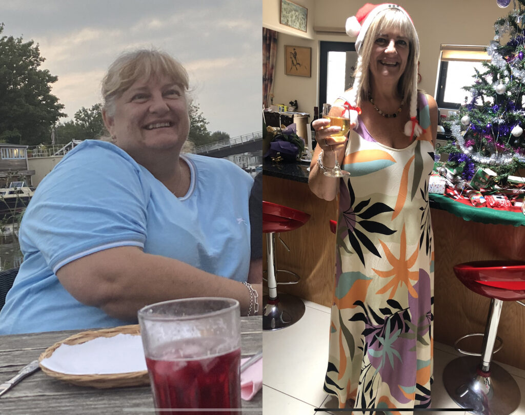 Gastric Bypass Transformation Before and After