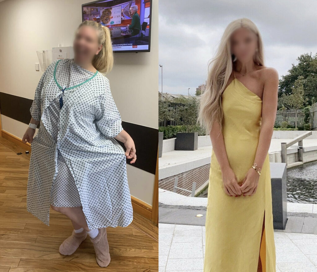 Woman’s photo before gastric sleeve surgery operation