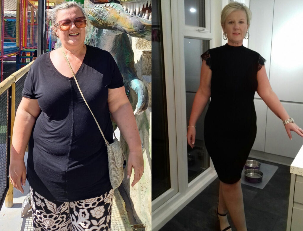 Photo of woman before gastric sleeve surgery