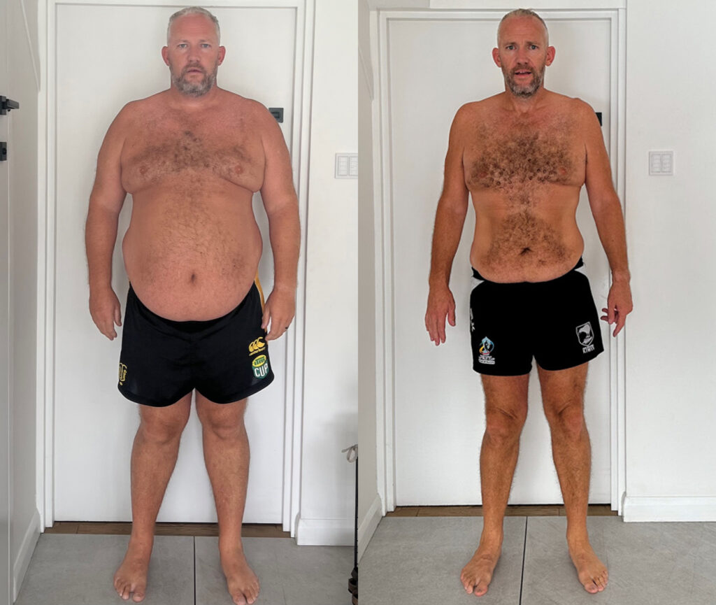 Man before gastric sleeve procedure photo