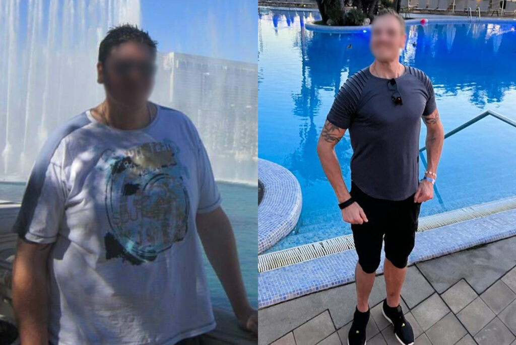 Photo of patient prior to gastric sleeve surgery