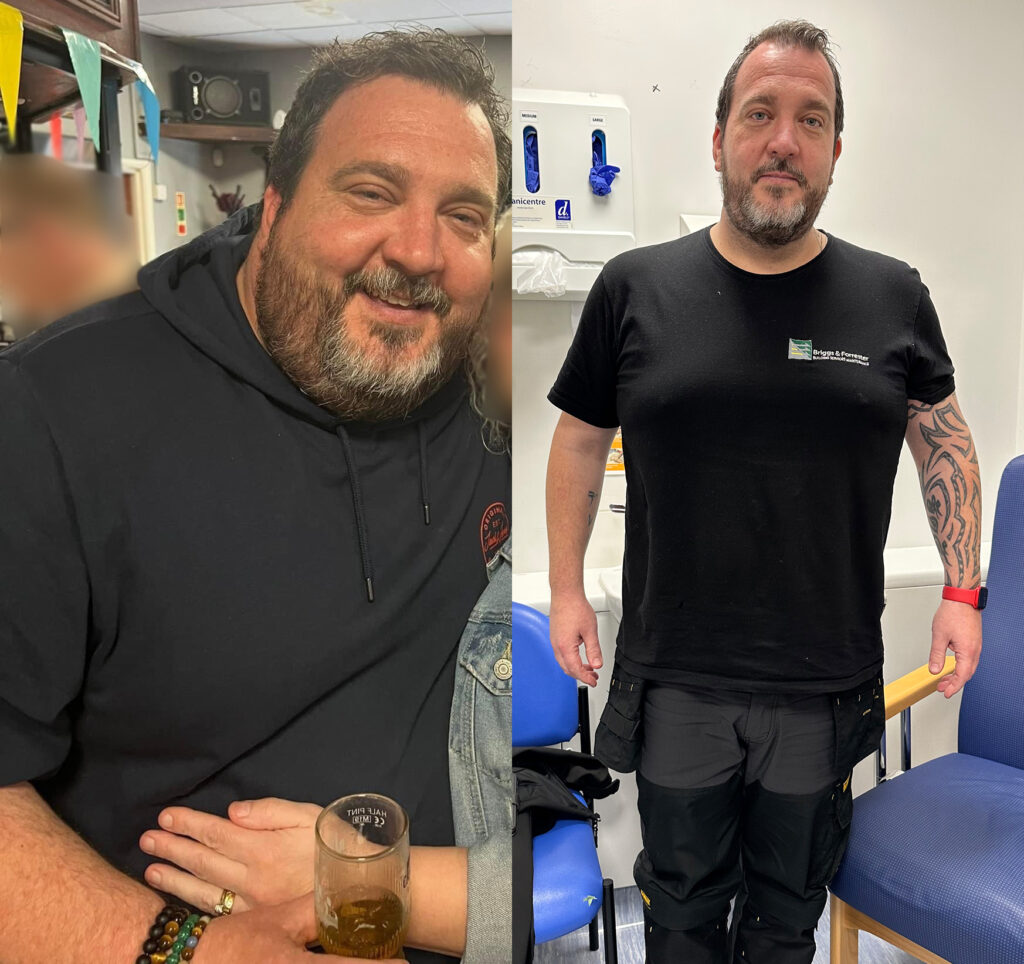 Photo before gastric sleeve surgery