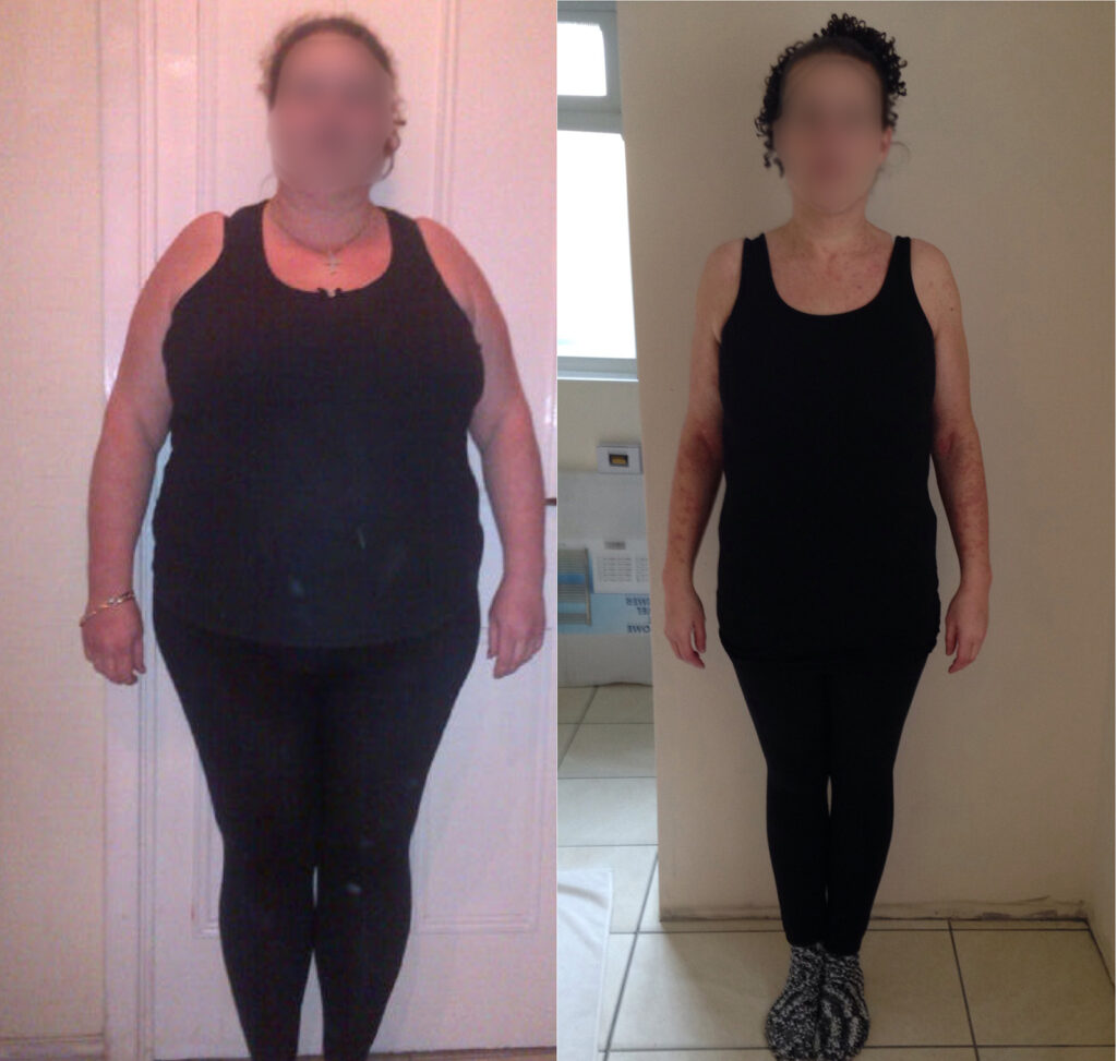Life-Changing Gastric Bypass Results Before and After
