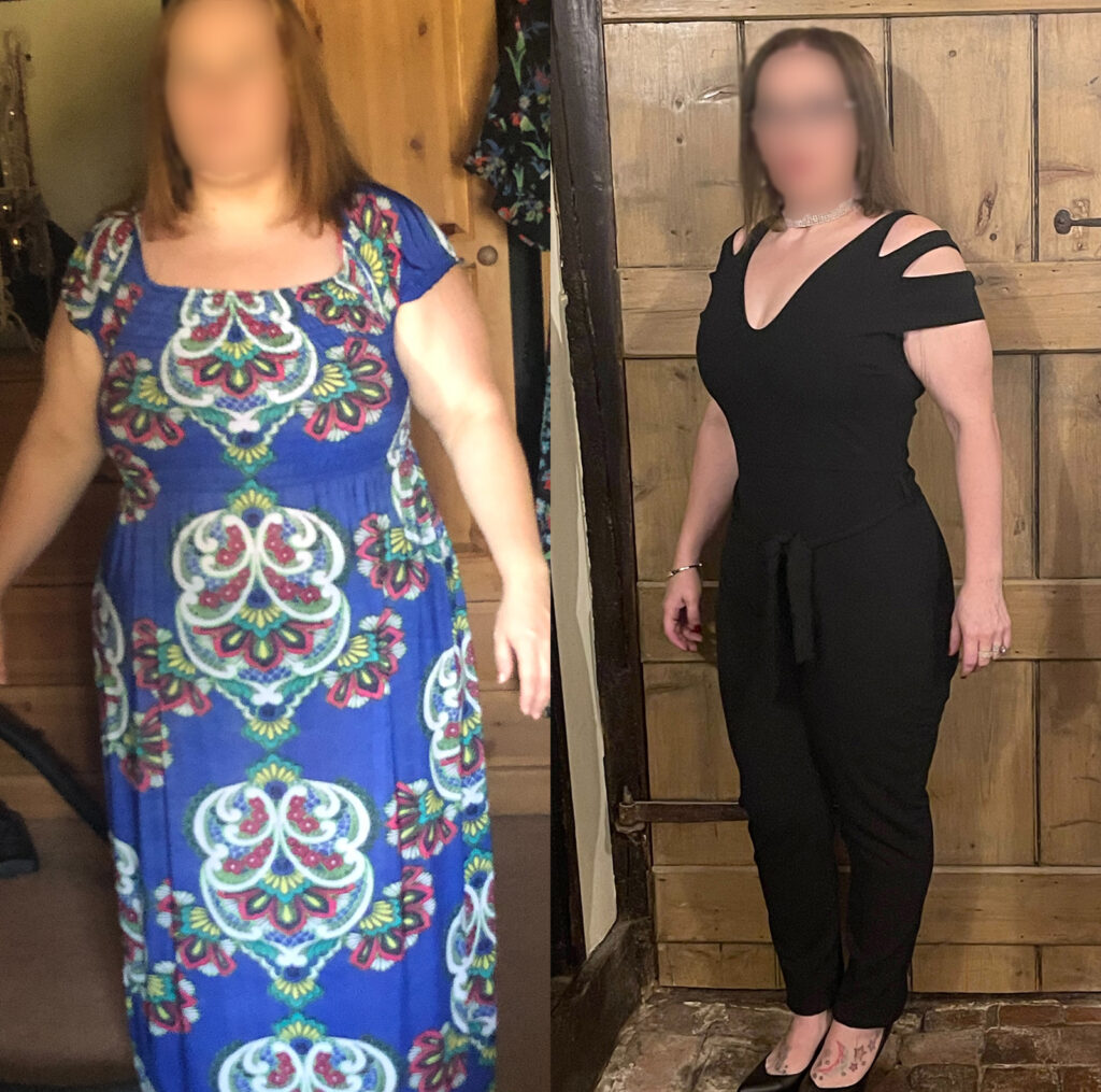 Gastric Bypass Surgery Before and After Transformation