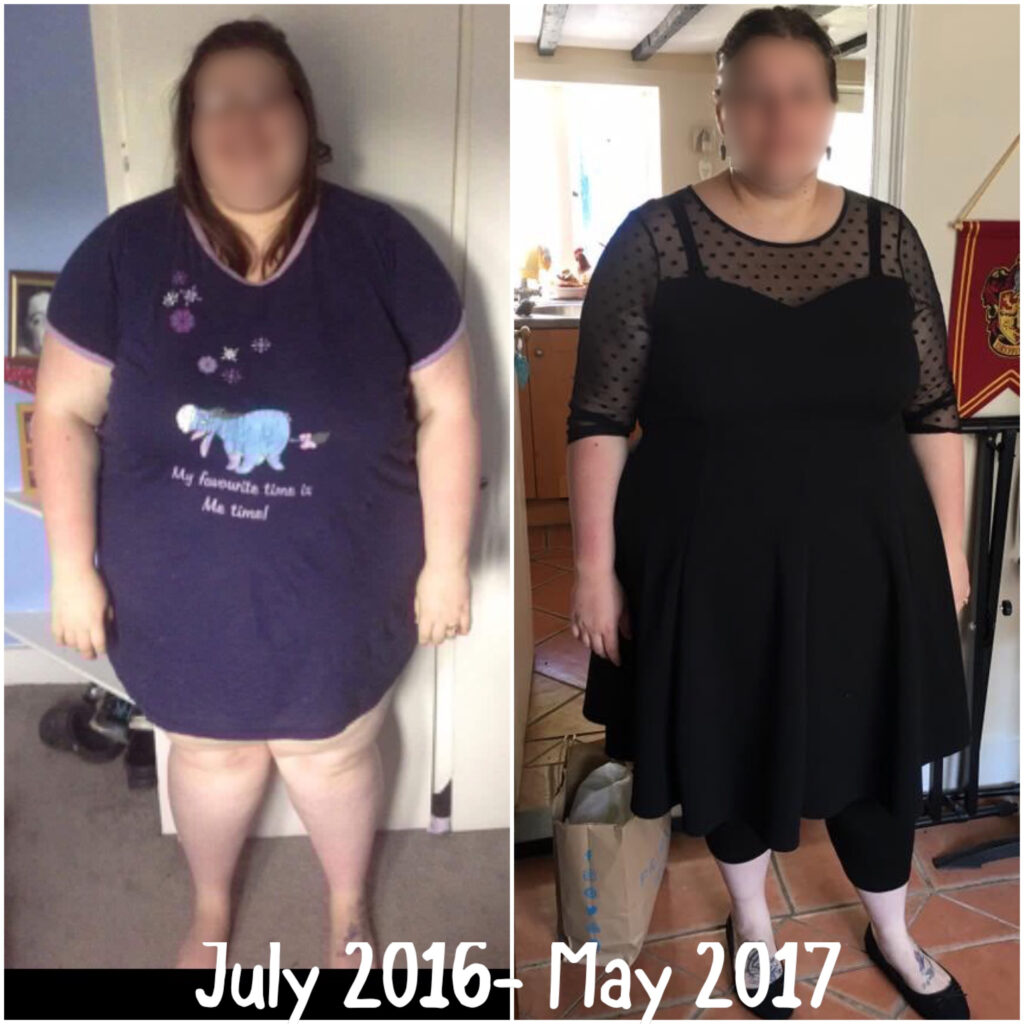 Before gastric sleeve operation photo