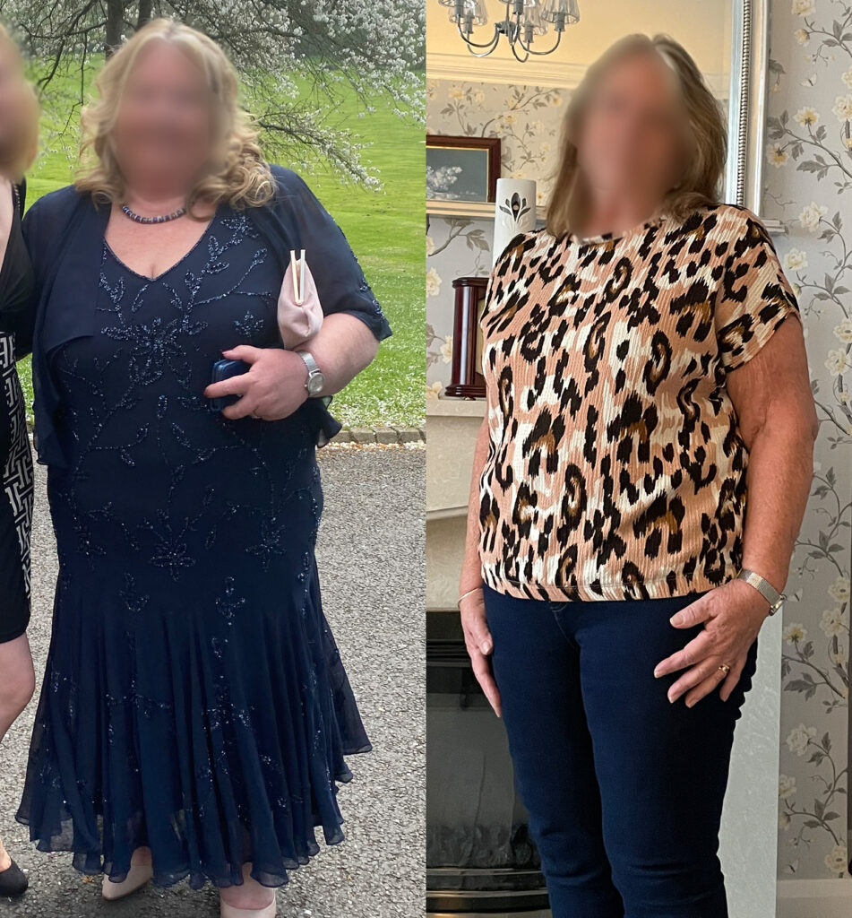 Gastric Bypass Before and After Photos