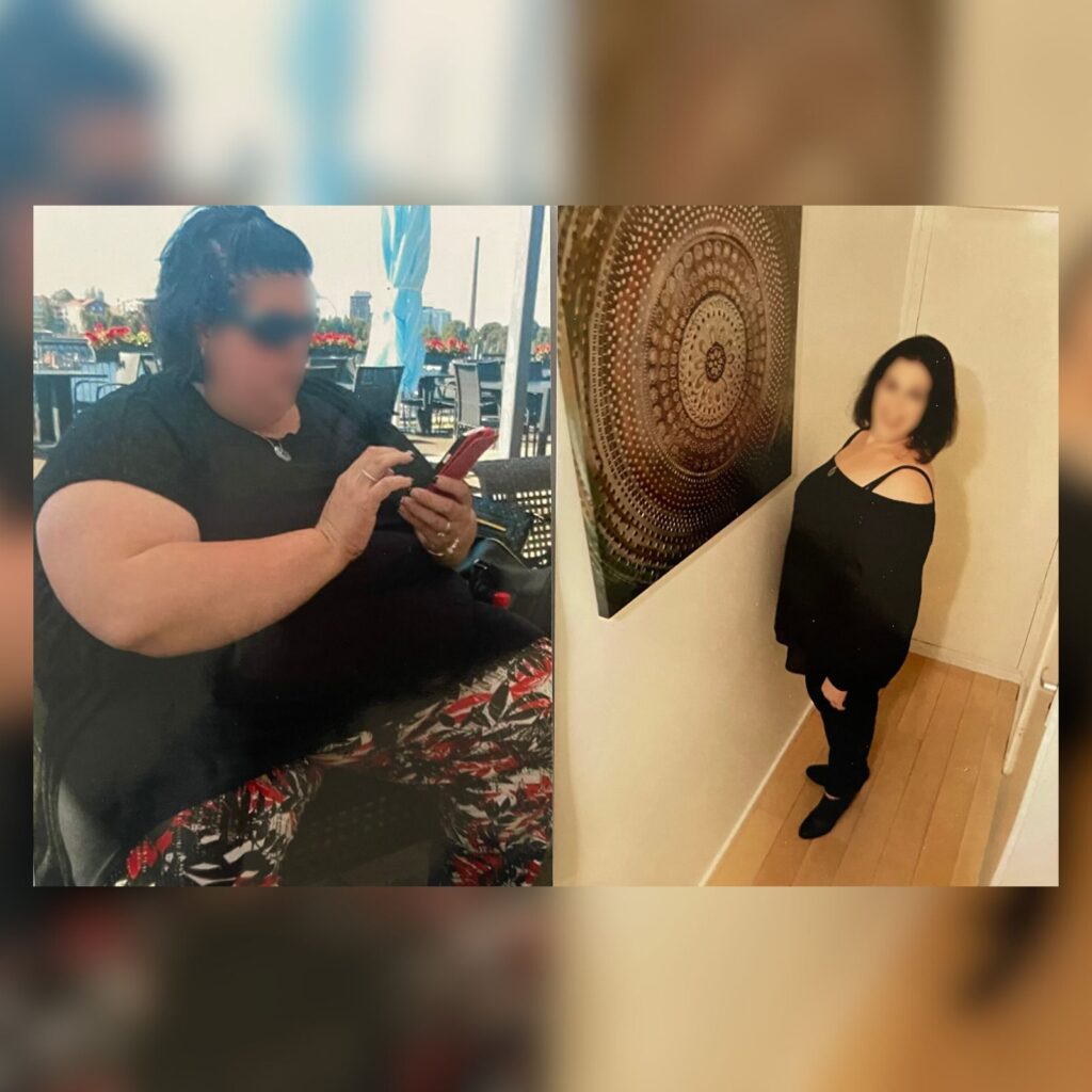Gastric bypass before and after weight loss photo by Dr. Vasilikostas