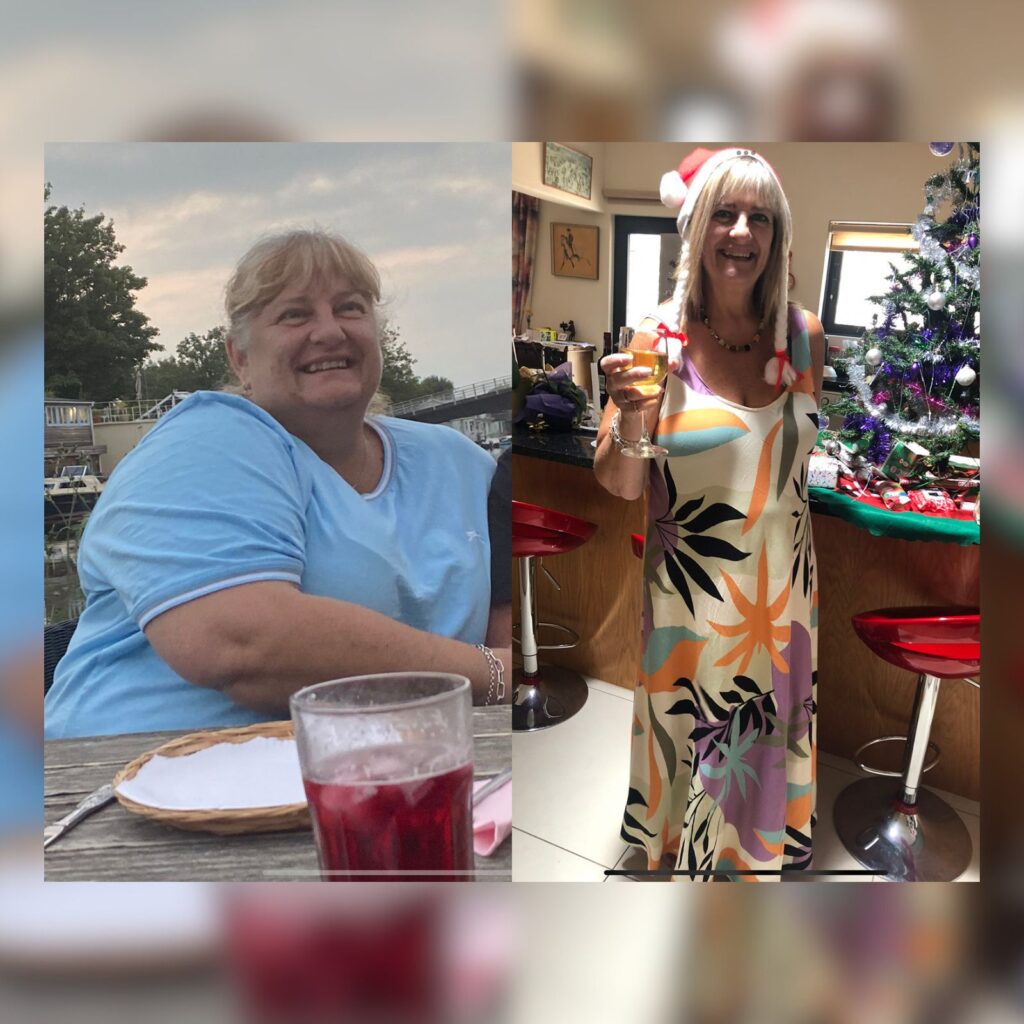 Gastric Bypass Transformation Before and After