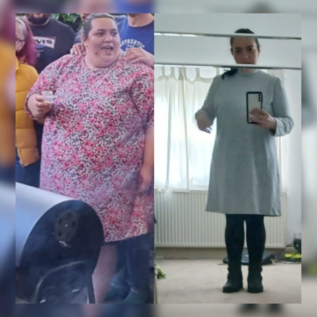 Gastric sleeve transformation photo by Dr Vasilikostas