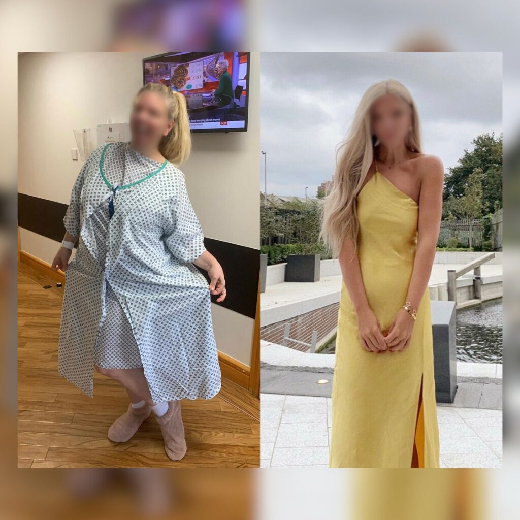 Gastric sleeve surgery before and after by Dr. Vasilikostas