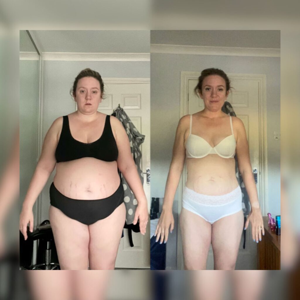 Gastric sleeve weight loss results before and after by Dr. Vasilikostas