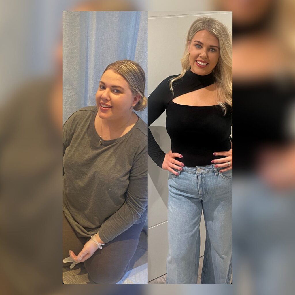 Gastric sleeve surgery results before and after photo by Dr. Vasilikostas