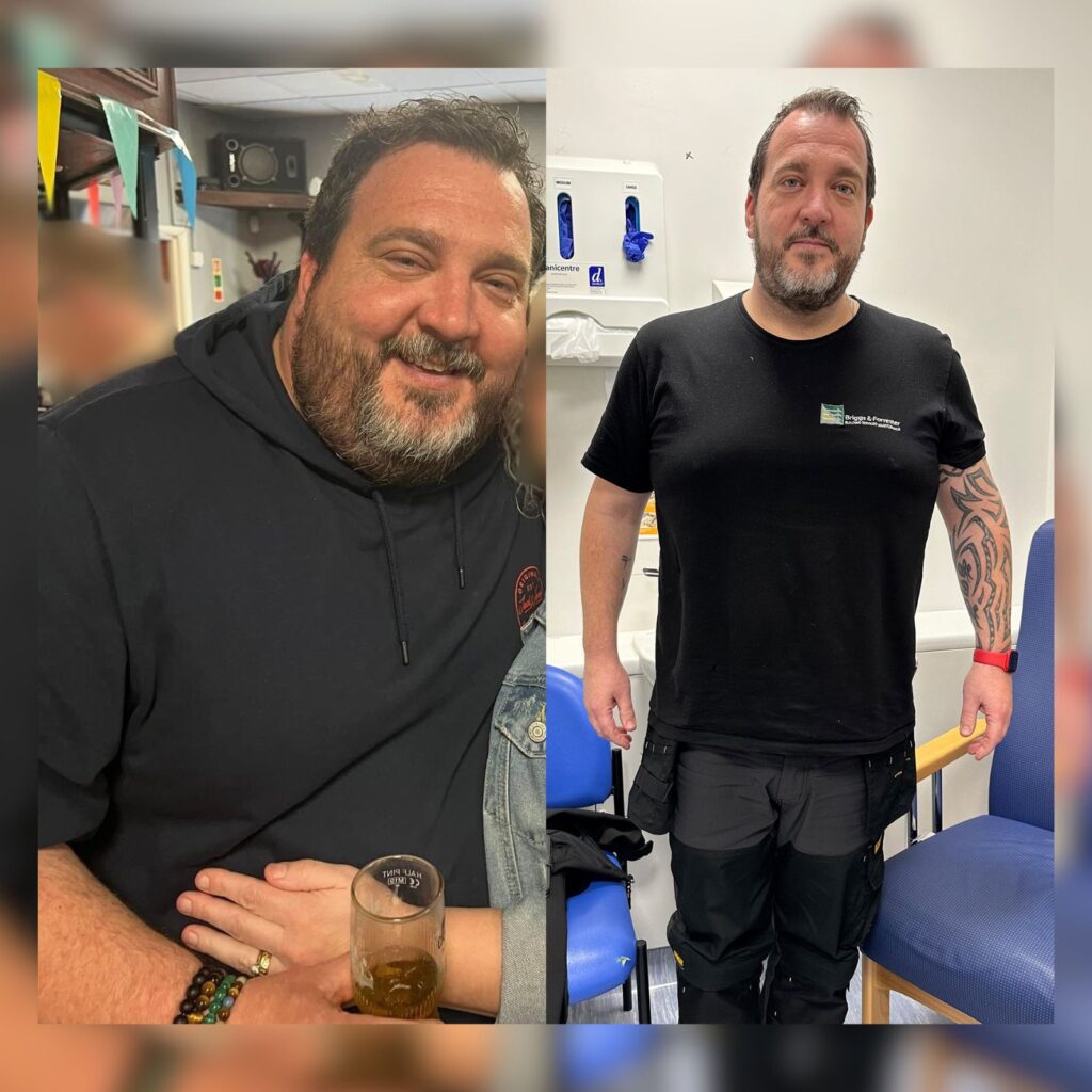 Gastric sleeve before and after weight loss success by Dr. Vasilikostas