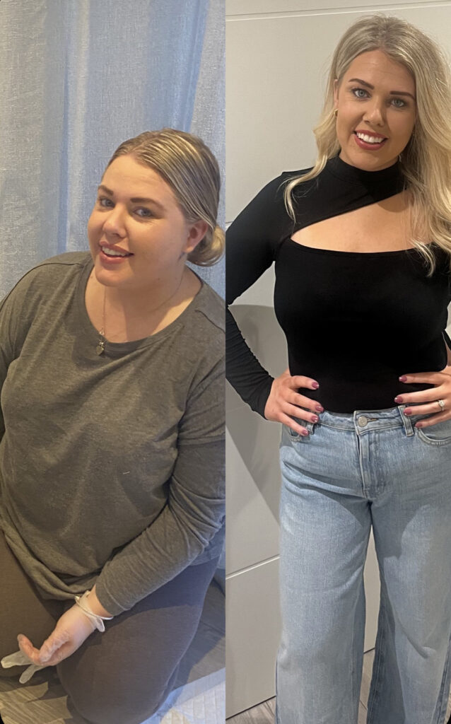 Woman before gastric sleeve surgery photo