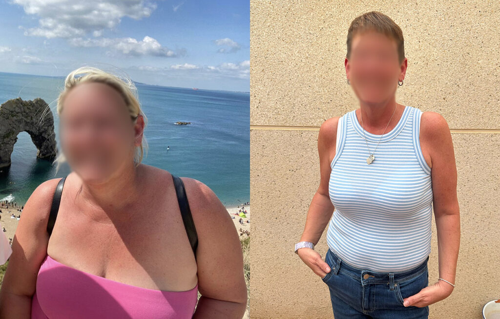 Female patient showing slimmer figure post gastric sleeve