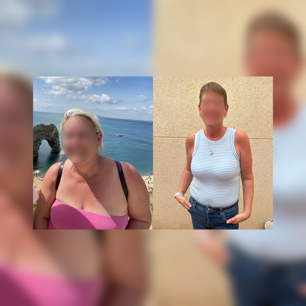 Female patient showing slimmer figure post gastric sleeve