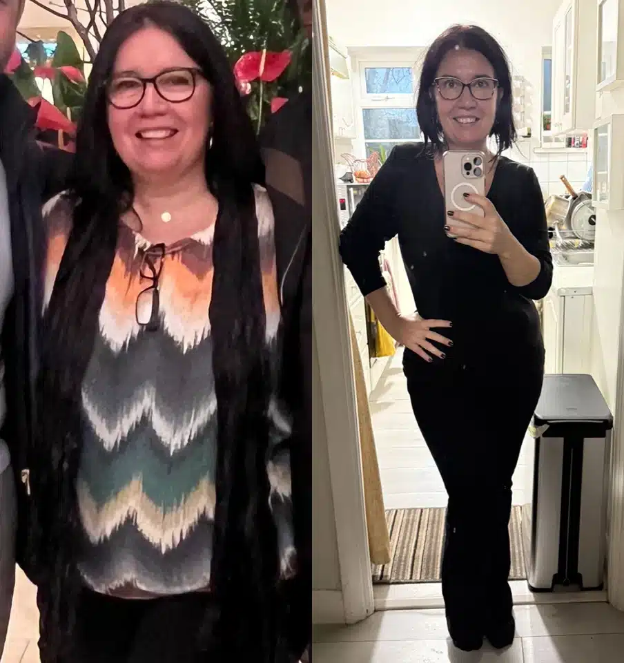 Before and after gastric sleeve weight loss comparison