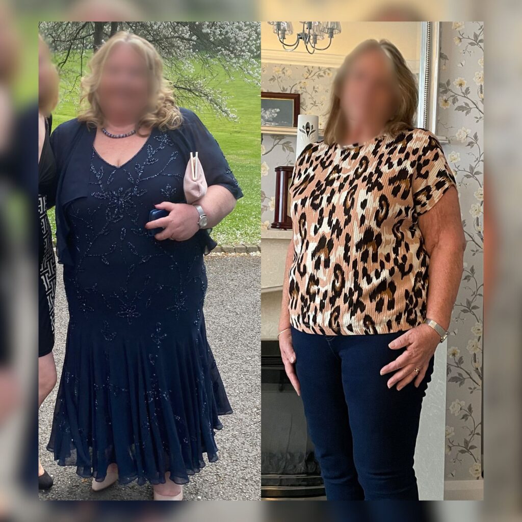 Gastric bypass before and after photo by Dr. Vasilikostas