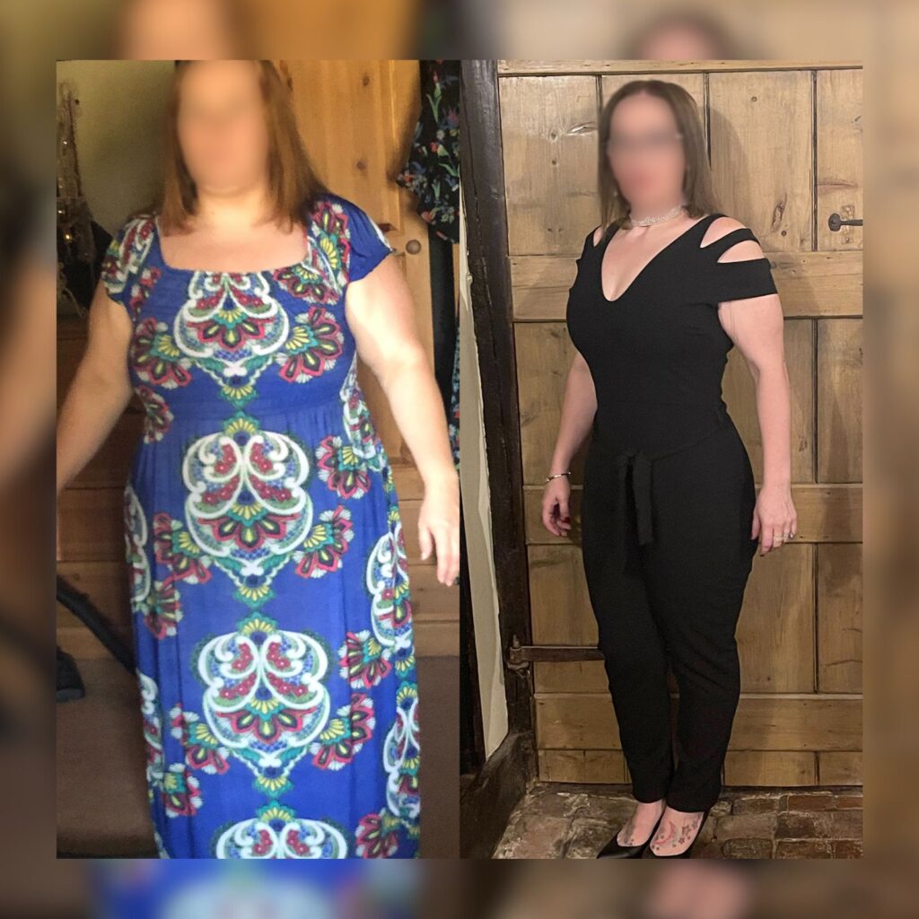 Gastric bypass surgery before and after by Dr. Vasilikostas