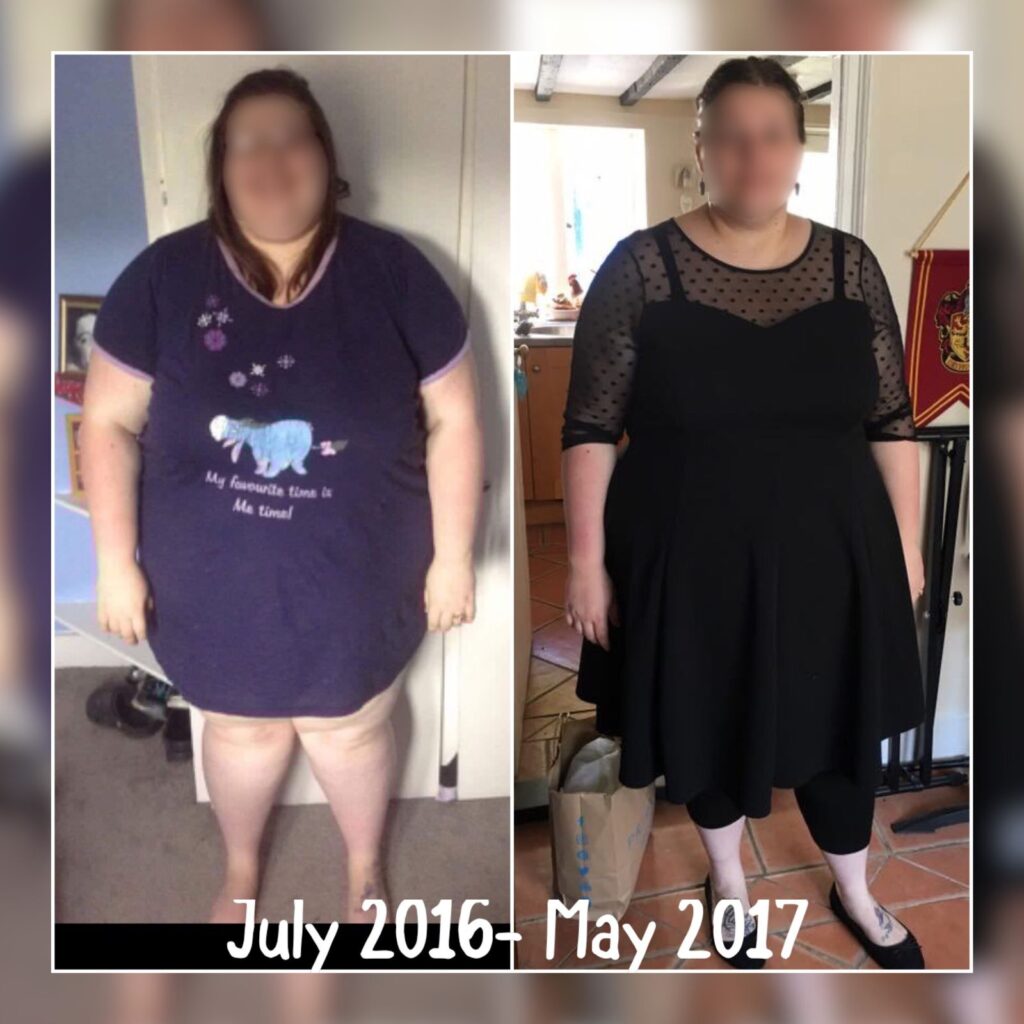 Gastric sleeve 5 months post-op weight loss by Dr. Vasilikostas