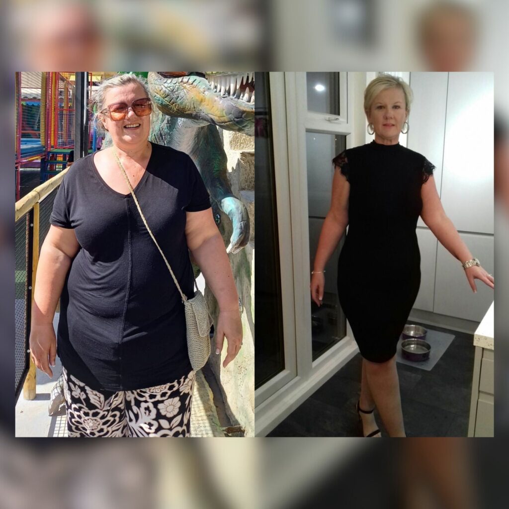 Dramatic weight loss following gastric sleeve procedure