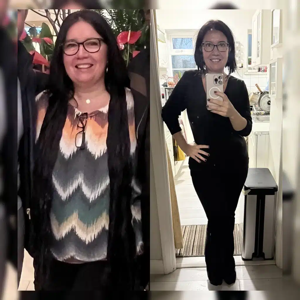 Before and after gastric sleeve weight loss comparison
