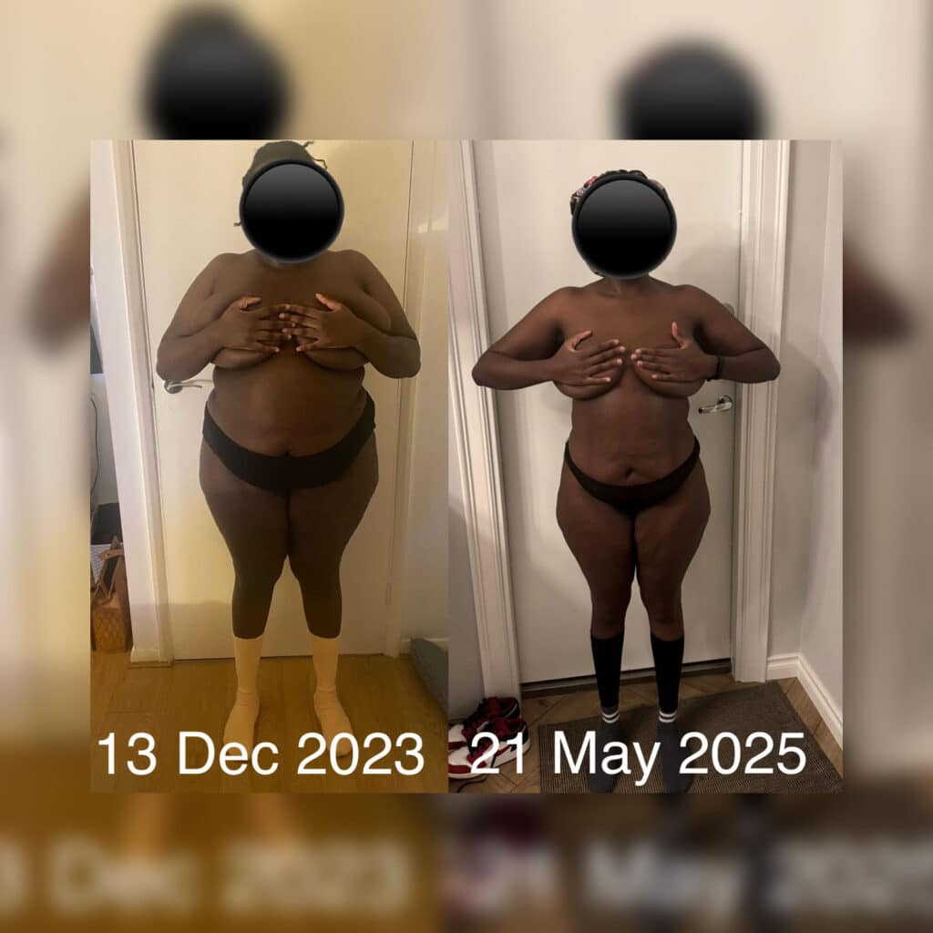 Patient progress photos after gastric bypass bariatric surgery